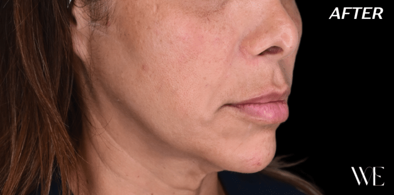 After Image: Cheek Filler, Chin Filler, Smile Line Filler, Lip Filler - right-front-oblique