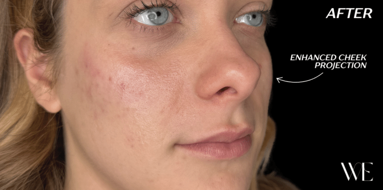 After Image: Cheek Filler - right-front-oblique