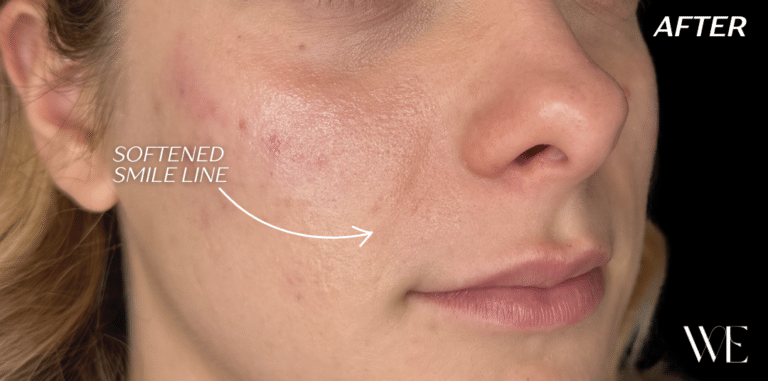 After Image: Cheek Filler - right-front-oblique