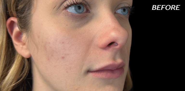 Before Image: Cheek Filler - right-front-oblique