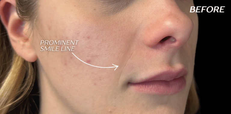 Before Image: Cheek Filler - right-front-oblique