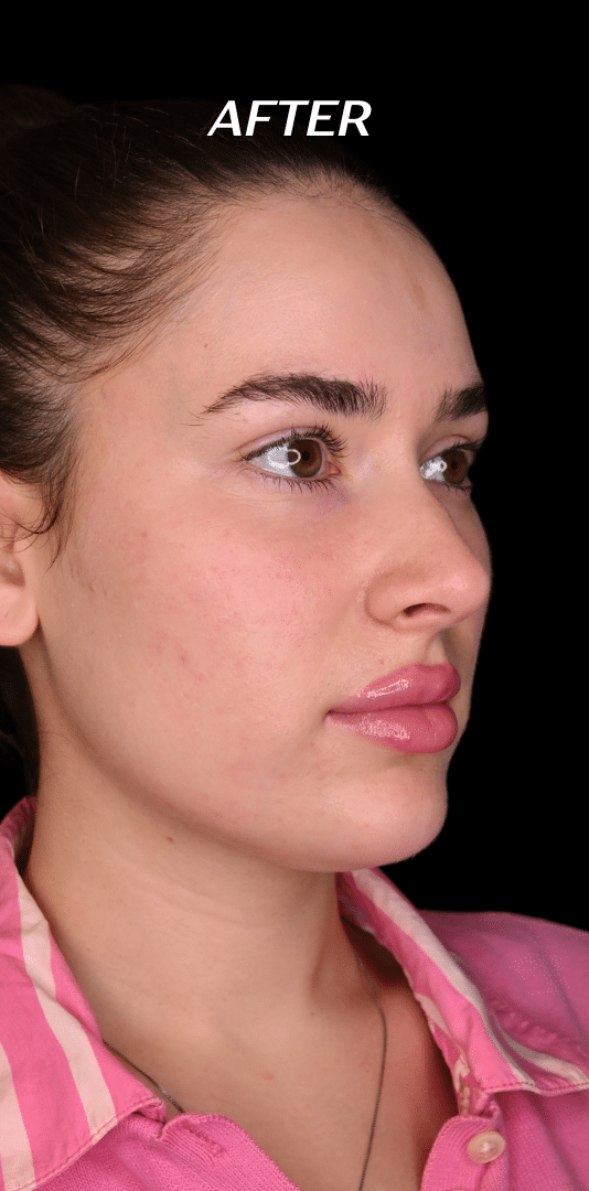 After Image: Lip Filler, Cheek Filler, Chin Filler - right-front-oblique