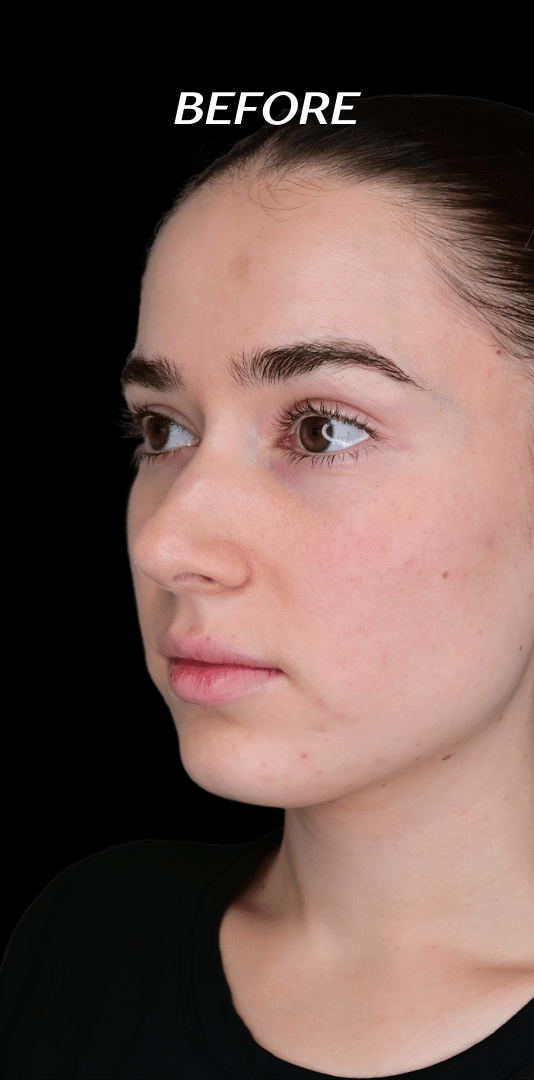 Before Image: Lip Filler, Cheek Filler, Chin Filler - left-front-oblique