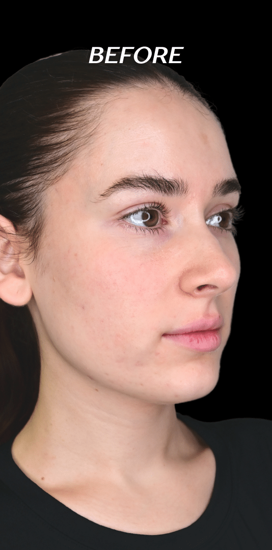 Before Image: Lip Filler, Cheek Filler, Chin Filler - right-front-oblique