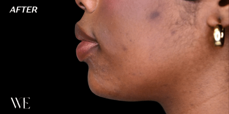After Image: Chin Filler - left-side