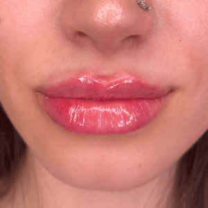 After Image: Lip Filler