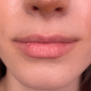 Before Image: Lip Filler