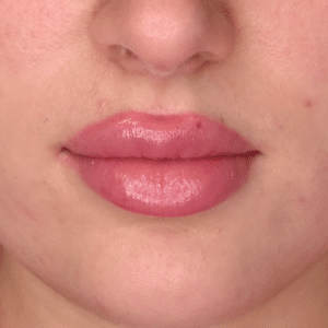 After Image: Lip Filler