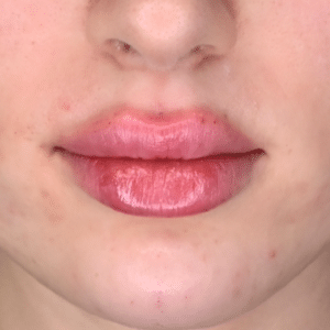 Before Image: Lip Filler