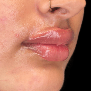 After Image: Lip Filler