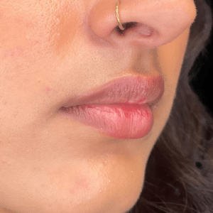 Before Image: Lip Filler