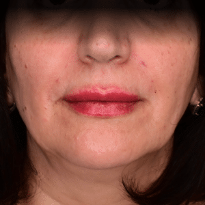 After Image: Smile Line Filler