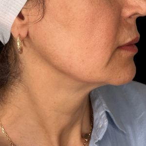 After Image: Jawline Filler