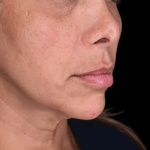 After Image: Smile Line Filler