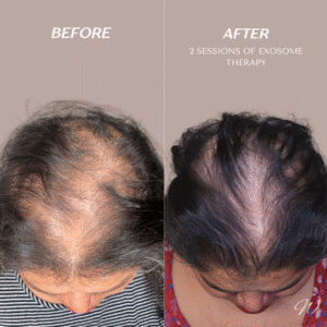 Rosa PRP Hair