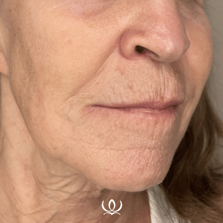 Before Image: DEKA CO2 - front