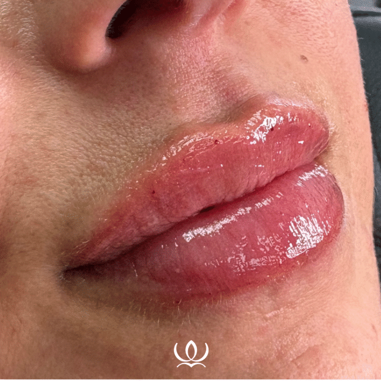 After Image: Lip Filler - front