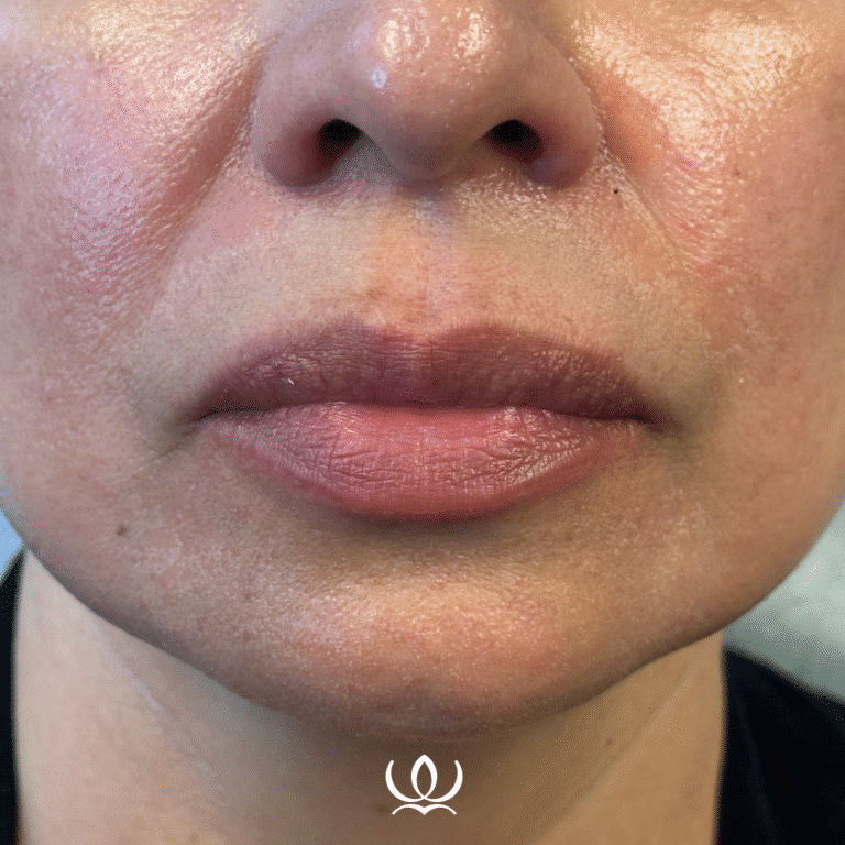 Before Image: Lip Filler - front