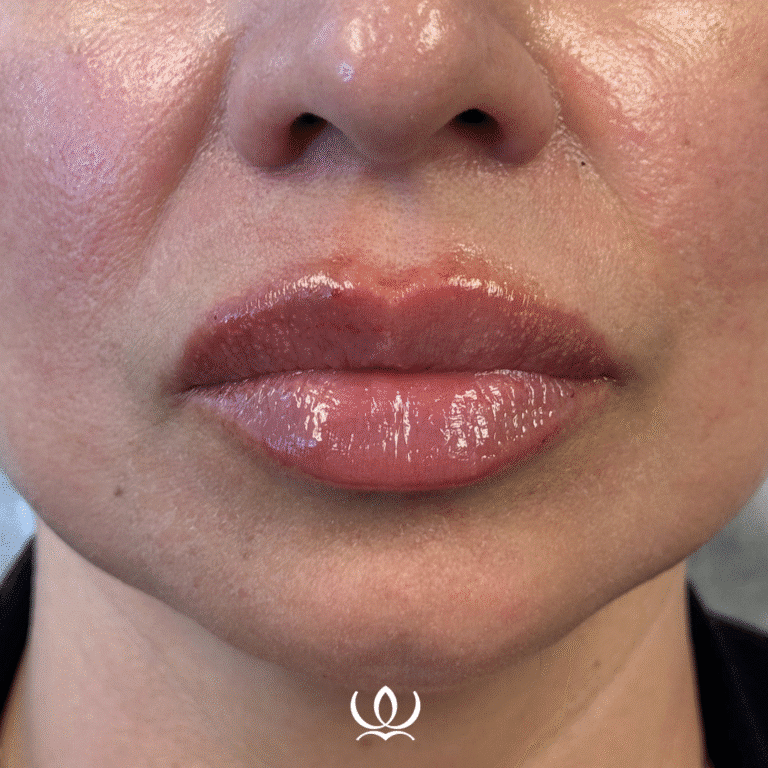 After Image: Lip Filler - front