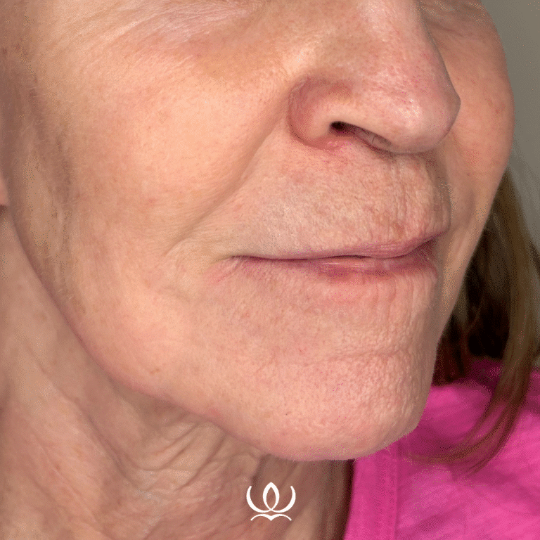 After Image: DEKA CO2 - front