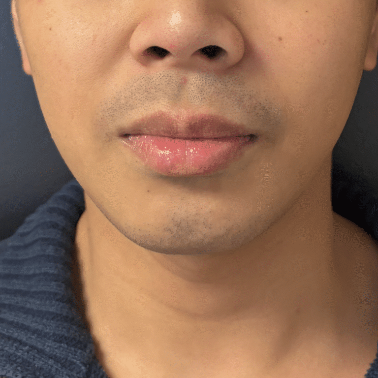 Before Image: Chin Filler - front