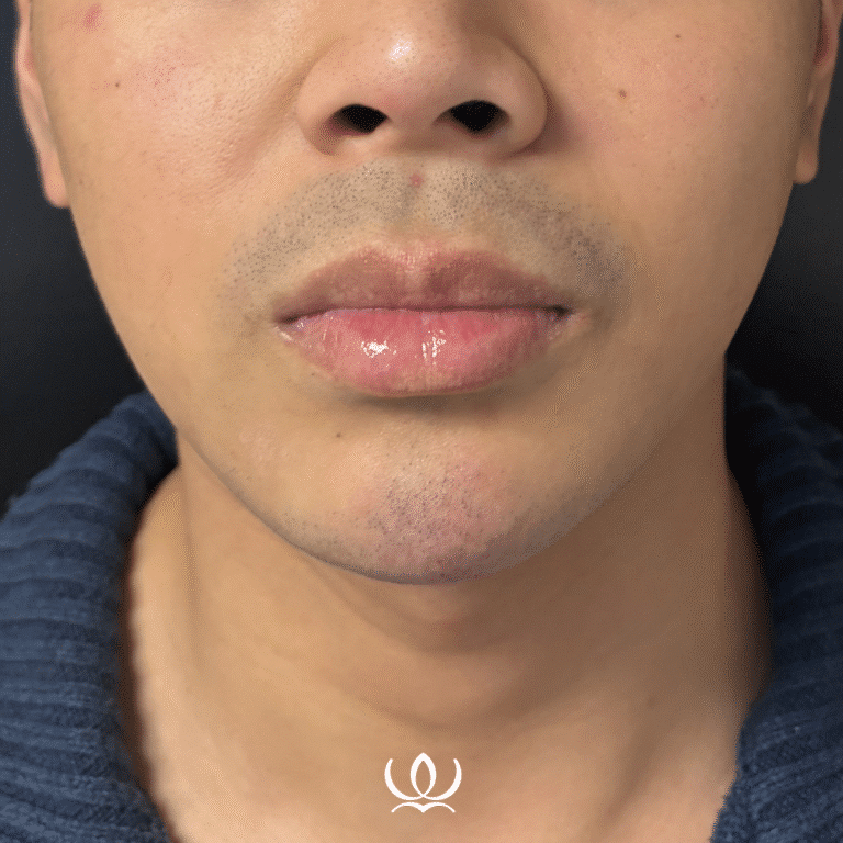 After Image: Chin Filler - front