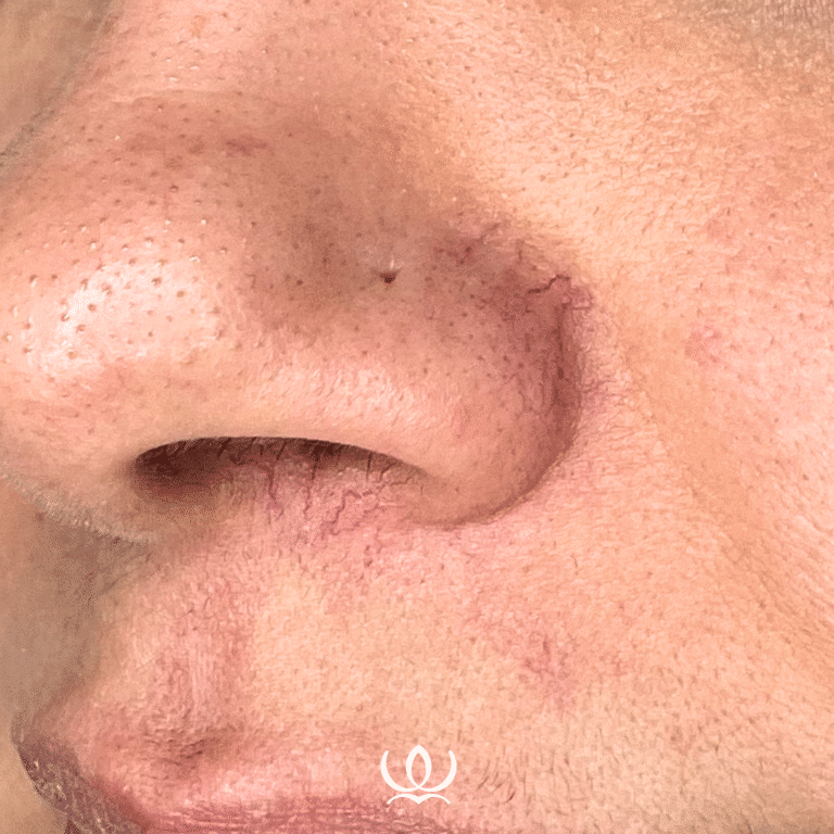 Before Image: V-Beam: Broken Capillaries - front