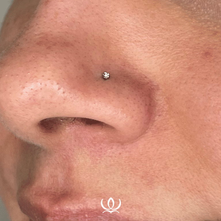 After Image: V-Beam: Broken Capillaries - front