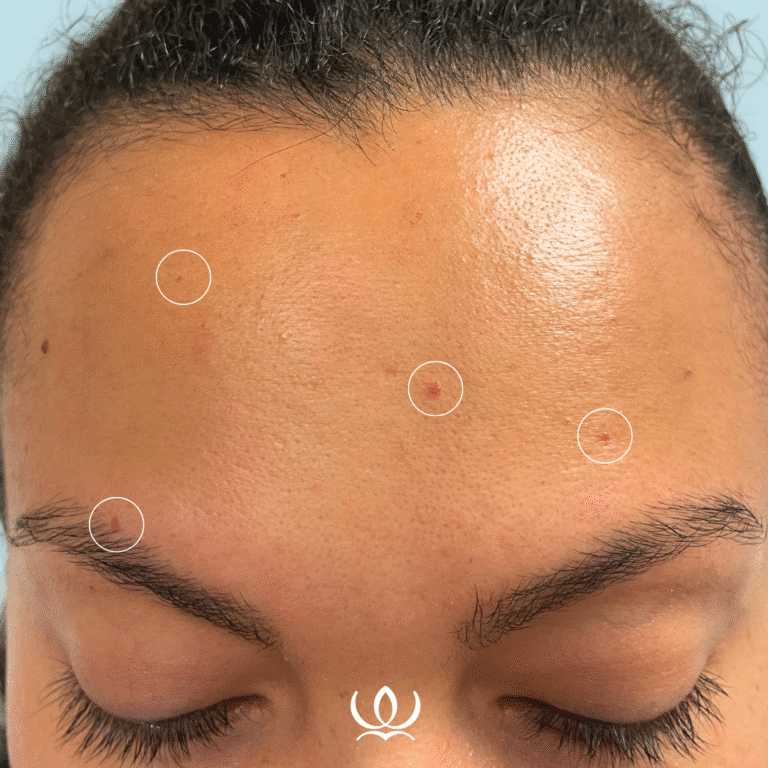 Before Image: V-Beam: Cherry Angiomas - front