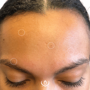 After Image: V-Beam: Cherry Angiomas