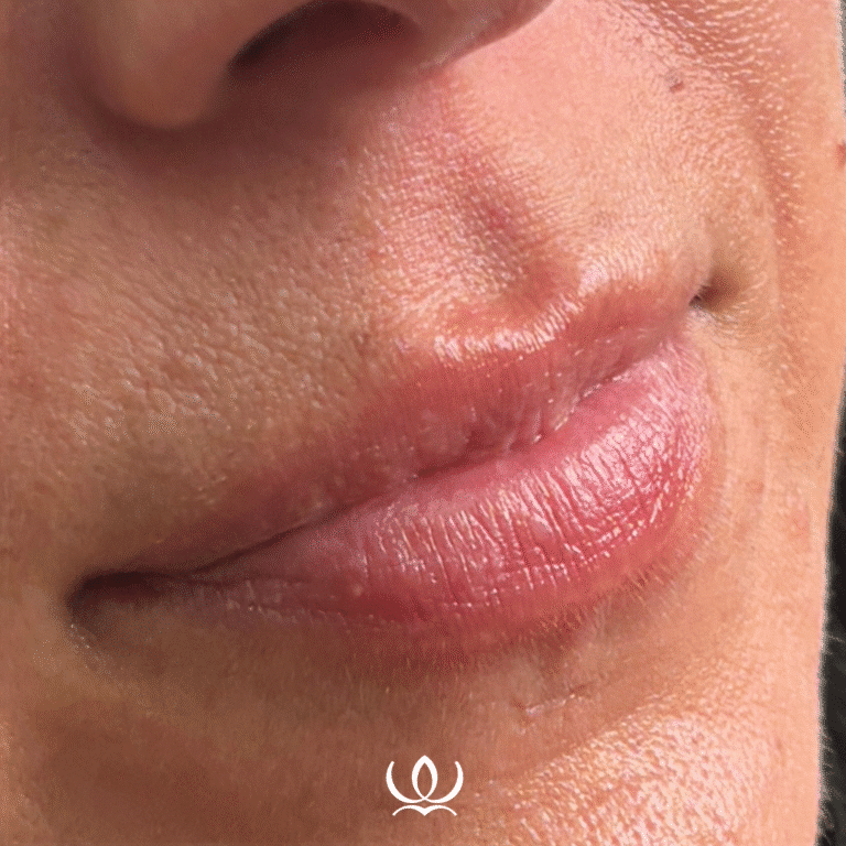 Before Image: Lip Filler - front
